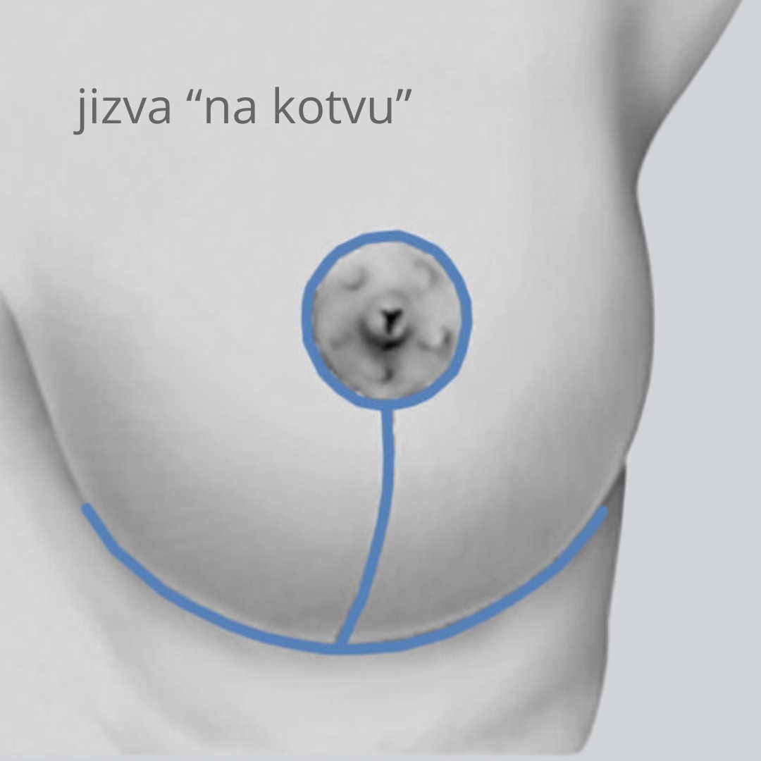 Jak vypadají jizvy po modelaci prsů?