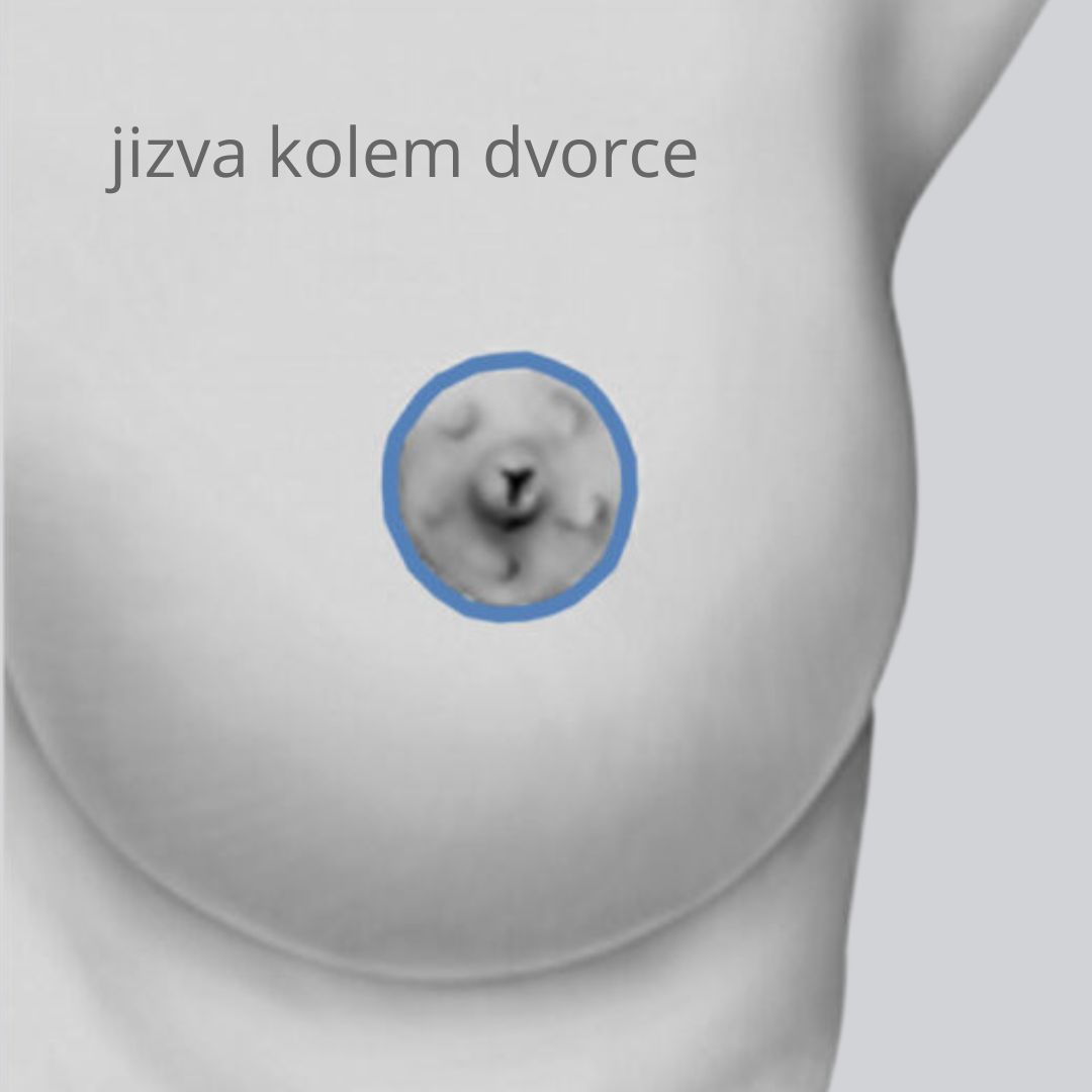Jak vypadají jizvy po modelaci prsů?